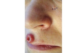 Bukan Bintitan, Benjolan Berkawah di Wajah Bisa Indikasikan Kondisi Langka