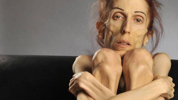 Potret Rachael Farrokh Lawan Anoreksia yang Bikin Bobotnya Hanya 18 Kg
