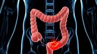 Fakta-fakta Gastroenteritis, Penyakit yang Diidap Balita di Blitar