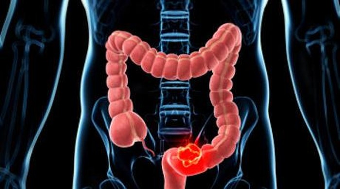 Makanan-makanan yang sering disangka menempel di usus. (Foto: thinkstock) Makanan-makanan yang sering disangka menempel di usus. (Foto: thinkstock)
