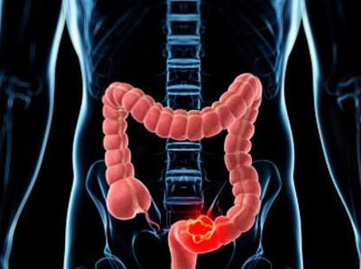 Fakta-fakta Gastroenteritis, Penyakit yang Diidap Balita di Blitar