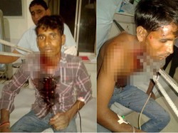 Bersyukur Bisa Selamat Setelah Leher Tertusuk Dua Batang Besi