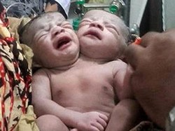 Bayi Perempuan Asal Bangladesh Ini Lahir dengan 2 Kepala