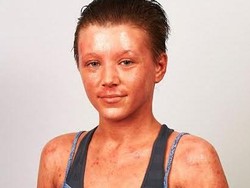 Pengobatan Eksim Malah Bikin Wanita Ini Merasa Seperti Lobster Rebus