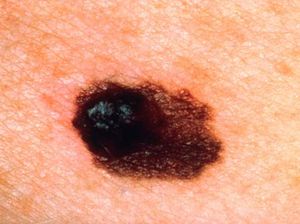 Sama-sama Kanker Kulit, Ini Bedanya Karsinoma dengan Melanoma Sama-sama Kanker Kulit, Ini Bedanya Karsinoma dengan Melanoma