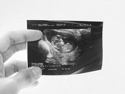 Ayudia Bing Slamet Hamil Anak Pertama