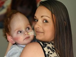 Kisah Aaron, Bocah Tanpa Otak yang Akhirnya Bisa Panggil Ibunya