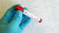 Kemenkes RI Pastikan Lonjakan Kasus HIV di Sidoarjo Bukan Karena Penularan Meningkat