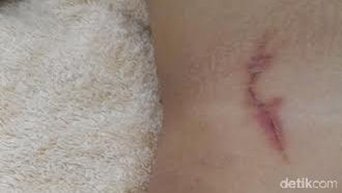 Dermatitis Venenata Kondisi dermatitis venenata