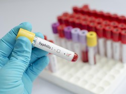 Peneliti: Sifilis di Eropa Tidak Dibawa oleh Christopher Columbus