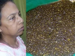 Dokter di India Angkat Ribuan Batu Empedu dari Tubuh Seorang Wanita