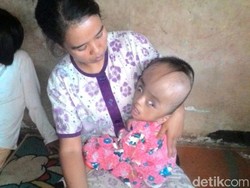 Selain Mengalami Gizi Buruk, Balita Ini Juga Mengidap Hidrosefalus