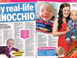 Ollie Trezise, Balita yang Terlahir dengan Hidung Seperti Pinocchio