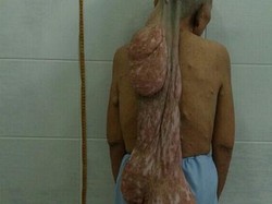 Tumor Sepanjang 70 Cm Diangkat dari Punggung Nenek Ini