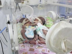 Bayi Kembar Siam Dempet Perut Lahir di Sidoarjo