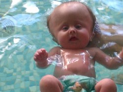 Lydia, Gadis Cilik Berkepala Besar Akibat Gangguan Otak Langka