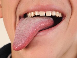 Sebab-sebab Mulut Terasa Pahit, Bukan Cuma Karena Sakit (2) Sebab-sebab Mulut Terasa Pahit, Bukan Cuma Karena Sakit (2)