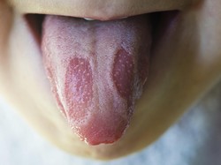 4 Kondisi Kesehatan yang Bisa Terlihat dari Lidahmu (1)