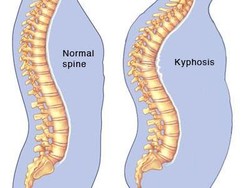 Tiga Ragam Kelainan Tulang Belakang