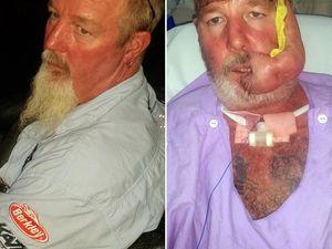 Dikira Herpes Biasa, Wajah Pria Ini Ternyata Digerogoti Kanker