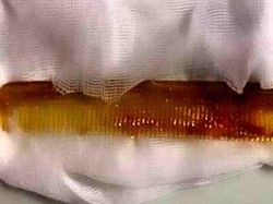 Astaga! Sisir Tertelan Saat Digunakan untuk Dorong Obat ke Tenggorokan