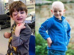 Mata Bengkak Setelah Dilempar Mainan Plastik, Ternyata Bocah Ini Kena Kanker