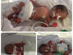 Bayi Kembar Lima dari Cirebon Sudah Lepas Alat Bantu