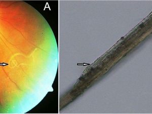 Penglihatannya Terganggu, Ternyata Ada Cacing di Mata Pria Ini