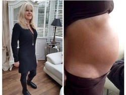 Perut Besar Seperti Ibu Hamil Kembar, Ternyata Ada Kista Seberat 12 Kg