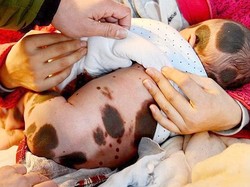 Kena Penyakit Langka, Bayi Ini Lahir dengan Kulit Penuh Belang Hitam