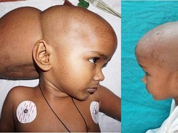 Renu, Bocah 4 Tahun dengan Tumor di Kepala Sebesar Bola Sepak