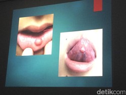 Pada Anak, Kebiasaan Gigit Bibir Bisa Picu Benjolan Seperti Ini