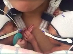 Kelahiran Prematur: Penyebab, Gejala, Cara Mengatasi