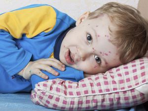 Waspada, 4 Penyakit Anak-anak yang Masih Bisa Terjangkit di Usia Dewasa Waspada, 4 Penyakit Anak-anak yang Masih Bisa Terjangkit di Usia Dewasa