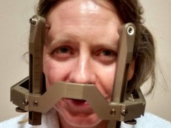 Bertahun-tahun Pendengaran Berkurang, Wanita Ini Tak Sadar Punya Tumor Otak