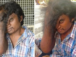 Berkat Turis Australia, Benjolan Seperti Belalai Ini Bakal Dioperasi