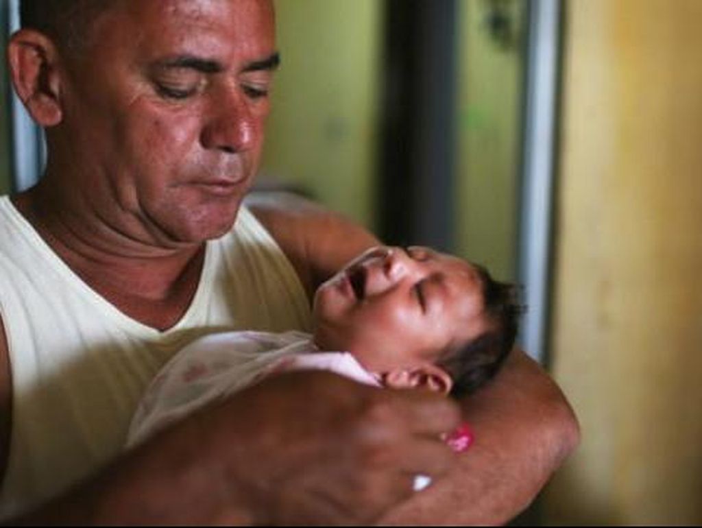 Bayi Pertama yang Lahir dengan Mikrosefali Akibat Zika Lahir di Amerika Bayi Pertama yang Lahir dengan Mikrosefali Akibat Zika Lahir di Amerika