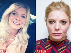 Alergi Parah, Kulit Wajah Wanita Ini Dipenuhi Bekas Luka dan Jerawat