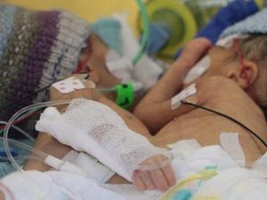 Tim Dokter Swiss Sukses Pisahkan Kembar Siam Termuda
