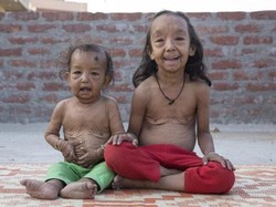 Kisah Kakak Beradik Usia 7 Tahun dan 18 Bulan yang Tampak Seperti Lansia