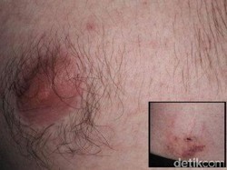 Pria Darwin Ini Pernah Didiagnosa Virus Zika Setelah Digigit Monyet di Bali