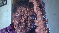 Menyedihkan! Potret Orang-orang dengan Tumor di Wajah Akibat Penyakit Langka