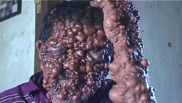 Menyedihkan! Potret Orang-orang dengan Tumor di Wajah Akibat Penyakit Langka