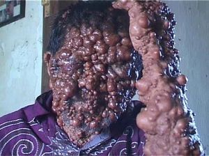 Menyedihkan! Potret Orang-orang dengan Tumor di Wajah Akibat Penyakit Langka