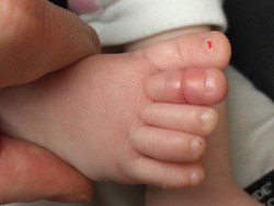 Hair Tourniquet, Ketika Sehelai Rambut Membuat Bayi Terancam Amputasi