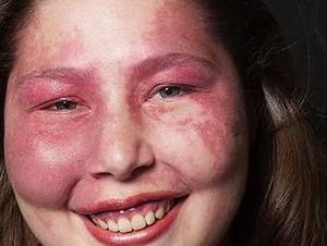 Ungkap Arti Cantik Sejati dari Wanita Albino & Penderita Sindrom Kulit Merah