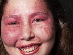 Ungkap Arti Cantik Sejati dari Wanita Albino & Penderita Sindrom Kulit Merah