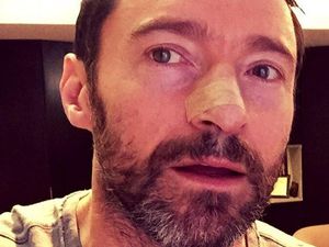 Kena Kanker Kulit, Ini Pesan Aktor Hugh Jackman