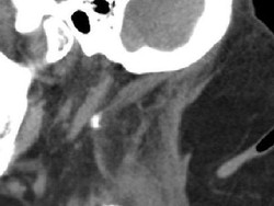 Tumbuh Punuk Akibat Kecanduan Alkohol