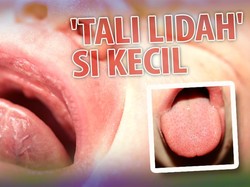 Pasca Frenotomi Bayi Dianjurkan Senam Lidah, Seperti Ini Prosedurnya